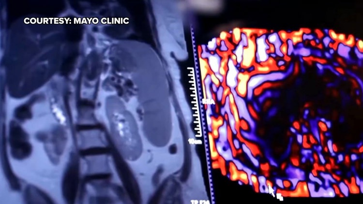 Healthy SA: Battling liver cancer, a disease which often has no symptoms early on — KENS 5 (San Antonio), Bowman Health news